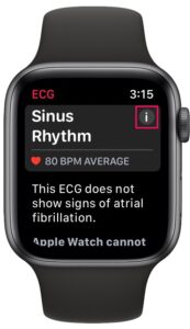Как записать ЭКГ на Apple Watch